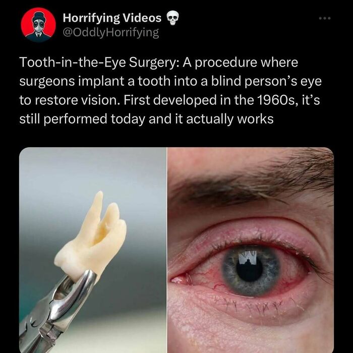 Tooth implant surgery shown, unnerving imagery of tooth extraction tool and a close-up of an eye.