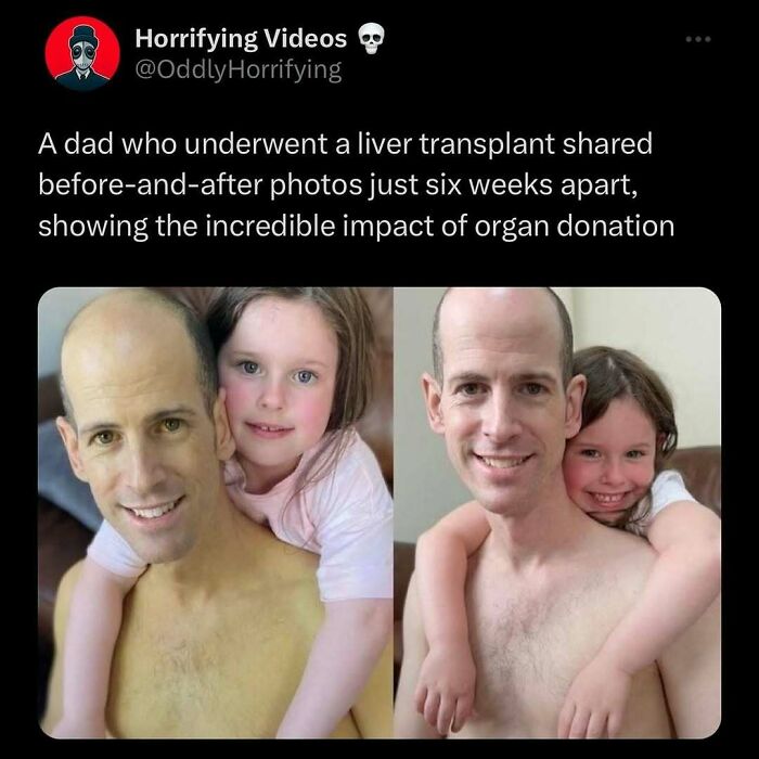Dad's liver transplant transformation with daughter, showcasing the impactful change in before-and-after photos.