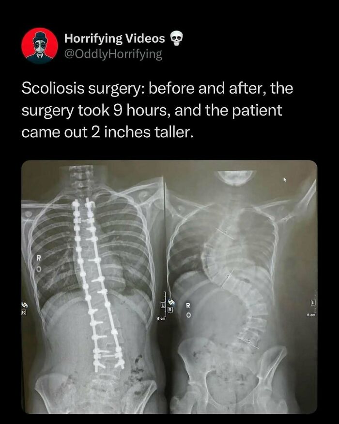 X-ray images of scoliosis surgery showing before and after results, highlighting unnerving spine transformation.