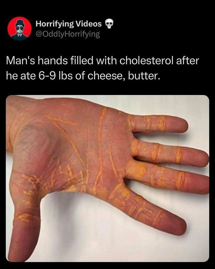 Oddly horrifying image of a man's hand streaked with orange from high cholesterol due to excessive cheese and butter consumption.