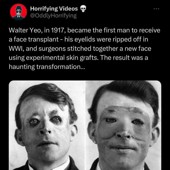 Before and after images of the first face transplant, showcasing a haunting transformation from 1917.