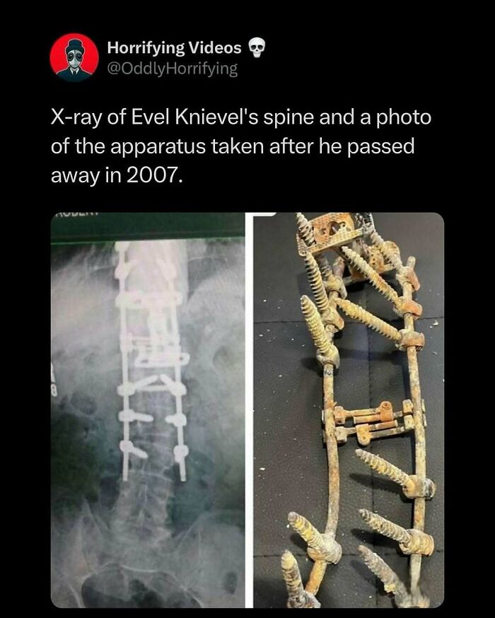 X-ray image and apparatus from Evel Knievel's spine, showcasing oddly horrifying medical equipment.