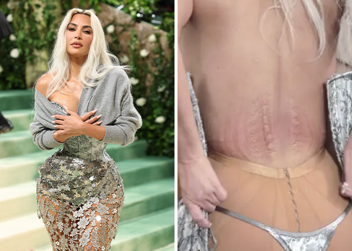 Celebrity in glamorous gown on red carpet, revealing unglamorous marks under the dress.