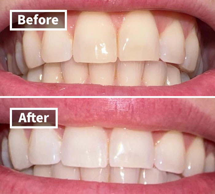 Before and after showing teeth whitening results from Amazon's spring sale favorite product.