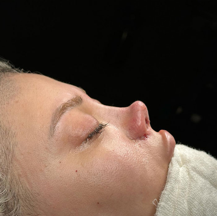 Close-up of a person's side profile showing a botched nose job.