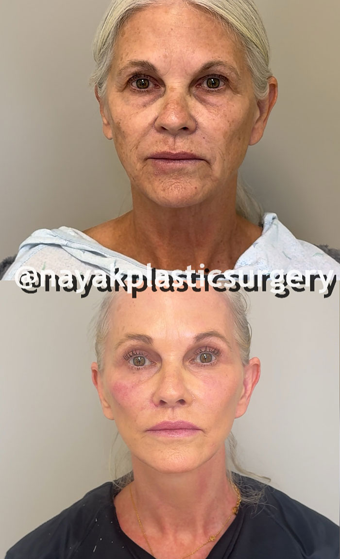 66YO woman before and after cosmetic surgery transformation, showcasing dramatic plastic surgery results. 66YO woman before and after cosmetic surgery transformation, showcasing dramatic plastic surgery results.