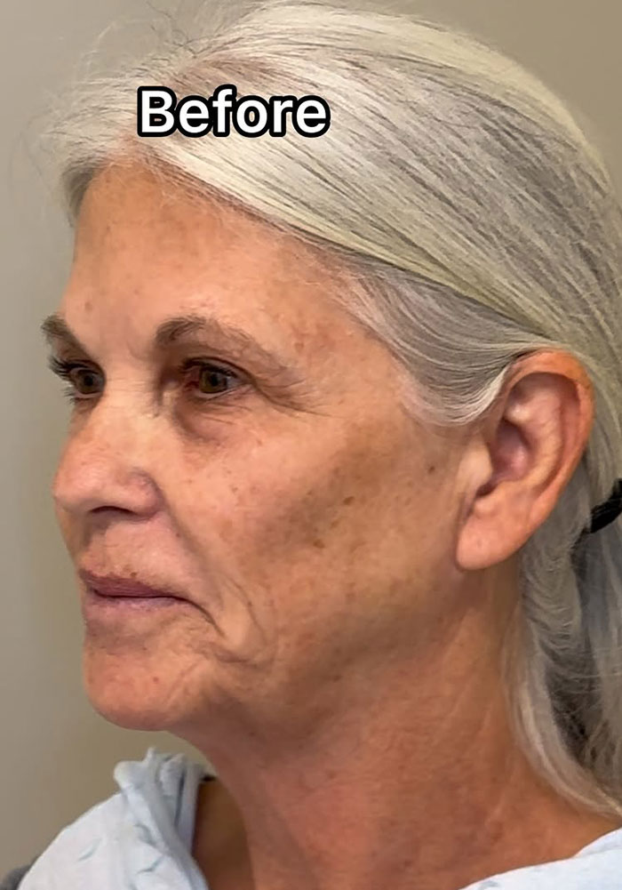 66-year-old woman before plastic surgery, showing natural aging signs. 66-year-old woman before plastic surgery, showing natural aging signs.