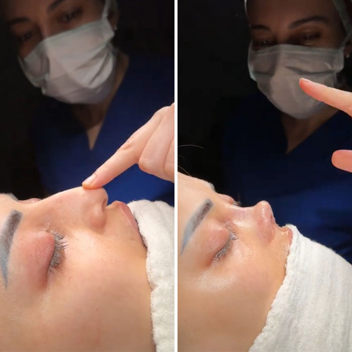 Close-up of a nose with a visible bump being examined, highlighting a botched nose job result.