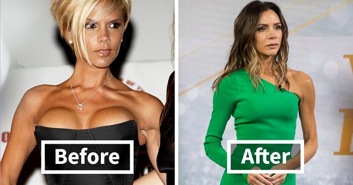 These 20 Celebs Had Their Breast Implants Removed—Before And After Photos Revealed