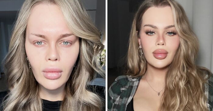 “Now Fix Your Bottom Lip”: YouTube Influencer Reveals Gory Eyelid Surgery Aftermath In New Video