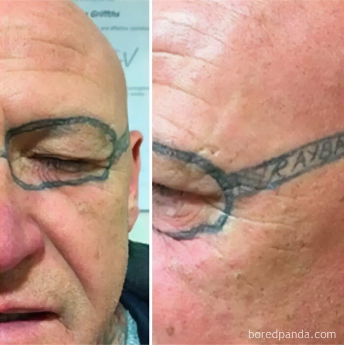 Close-up of a hilariously bad tattoo of eyeglasses on a man's face.