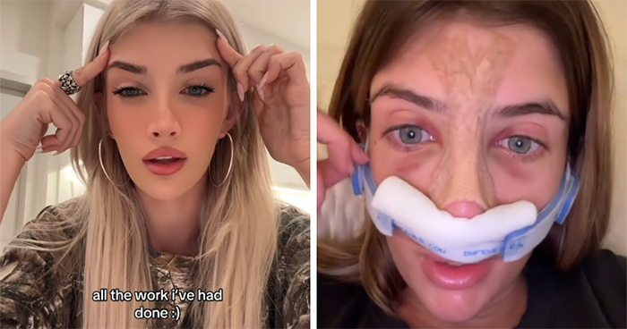 “Wish I Went Bigger”: Denise Richards’ Daughter Sami Sheen Reveals All Her Cosmetic Surgeries