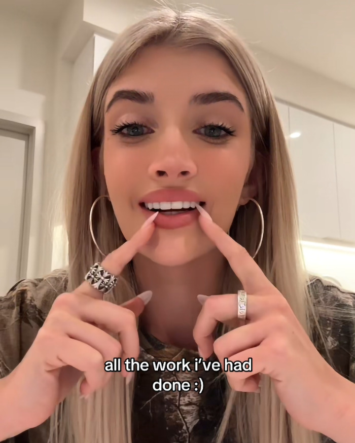 Young woman gesturing to her teeth, discussing her cosmetic surgeries in a kitchen setting.