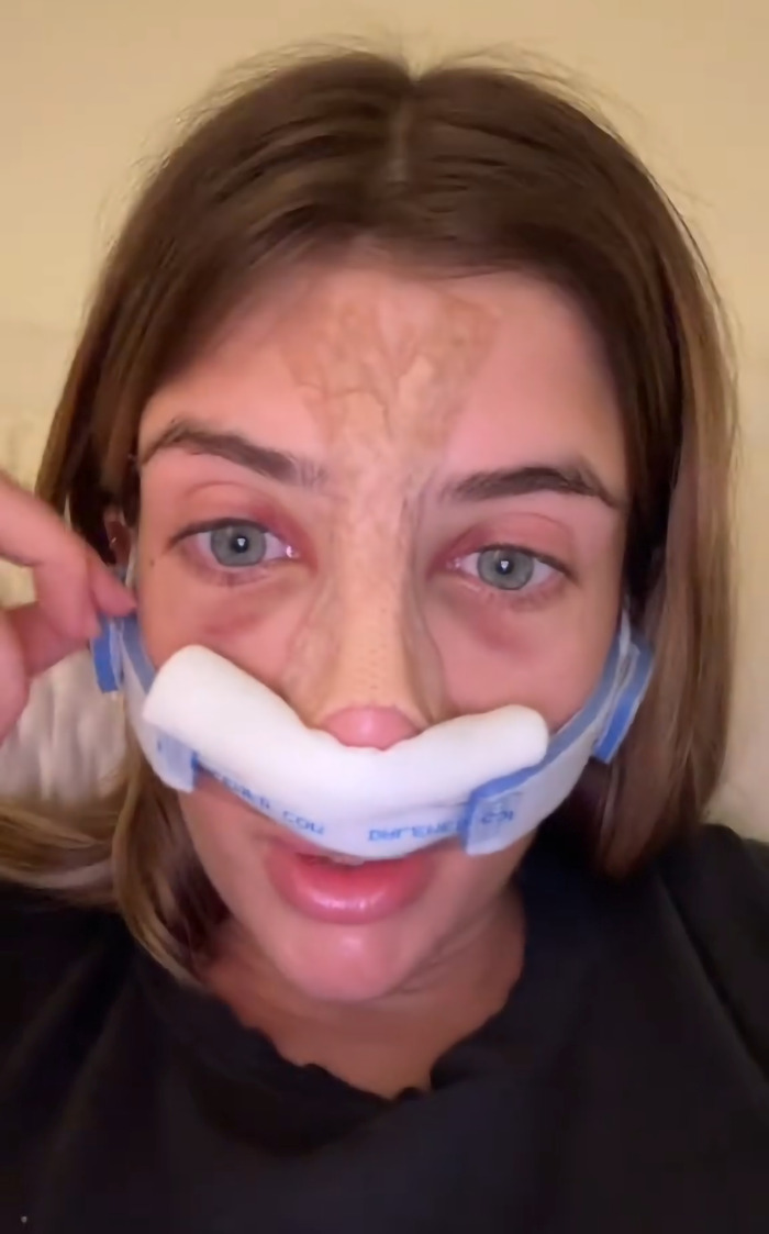 Young woman recovering from cosmetic surgery, wearing a nasal bandage and a black shirt, resting on a beige pillow.