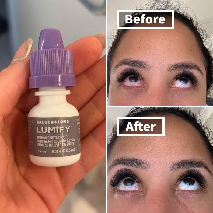 Eye redness treatment shown with Lumify drops, before and after results.