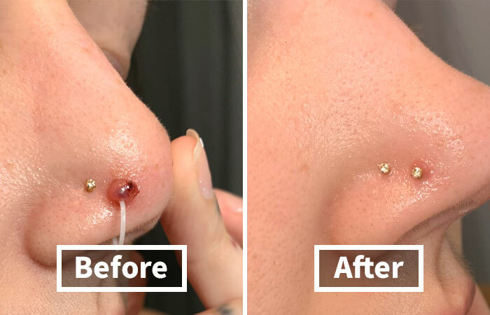Nose piercing infection before and after treatment, showing improved skin condition.