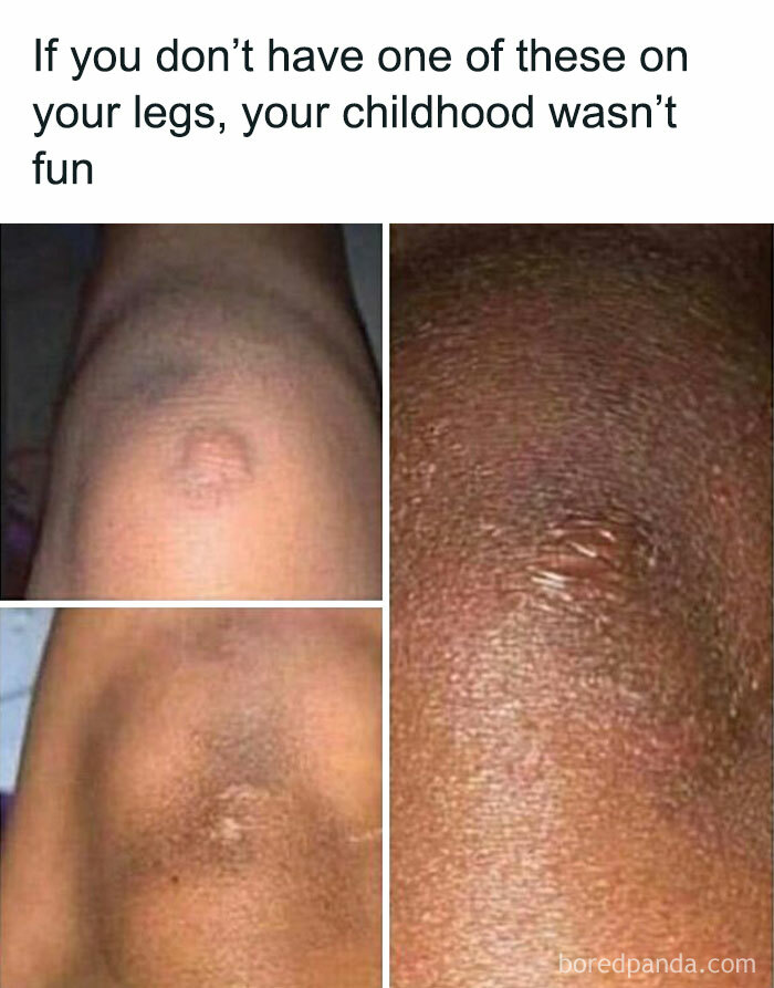 Close-up images of childhood scars on legs, showcasing funny childhood memories.