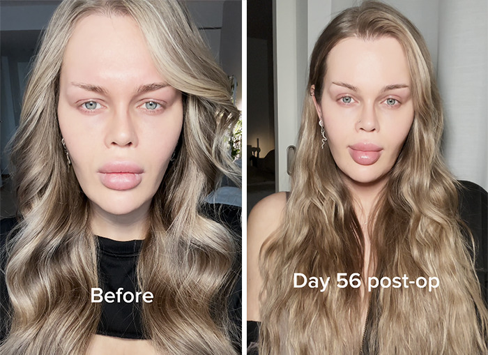 YouTube influencer shows eyelid surgery results, before and day 56 post-op, with long wavy hair and neutral expressions. YouTube influencer shows eyelid surgery results, before and day 56 post-op, with long wavy hair and neutral expressions.