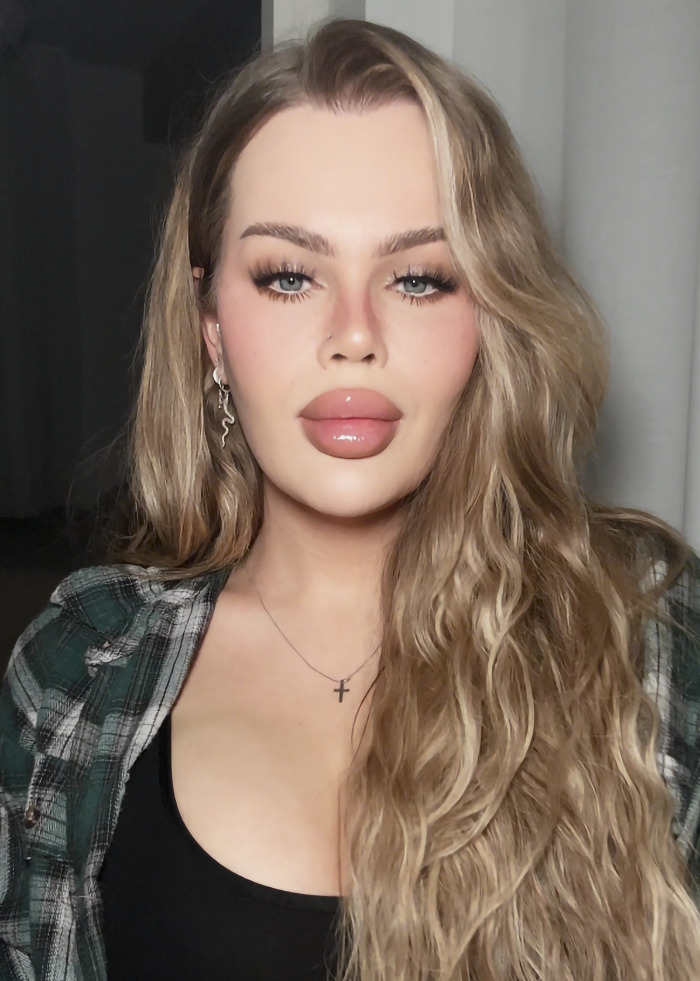 YouTube influencer with long blonde hair, wearing plaid shirt, revealing eyelid surgery aftermath. YouTube influencer with long blonde hair, wearing plaid shirt, revealing eyelid surgery aftermath.