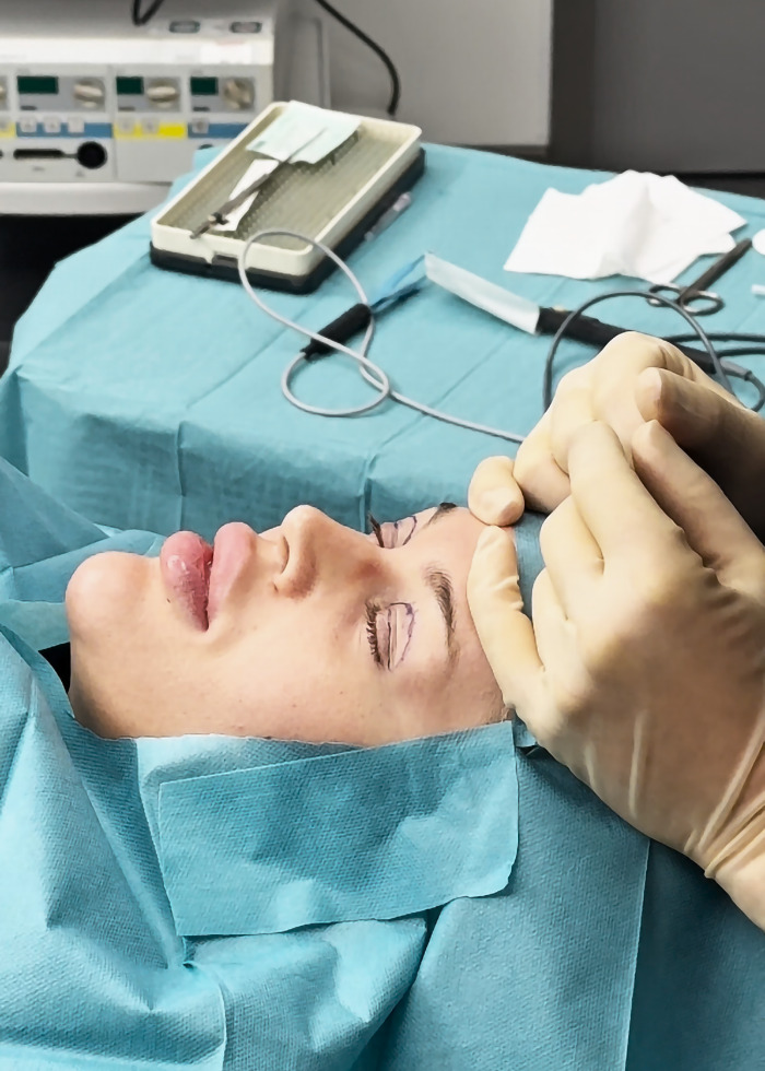 YouTube influencer undergoing eyelid surgery in a medical setting. YouTube influencer undergoing eyelid surgery in a medical setting.
