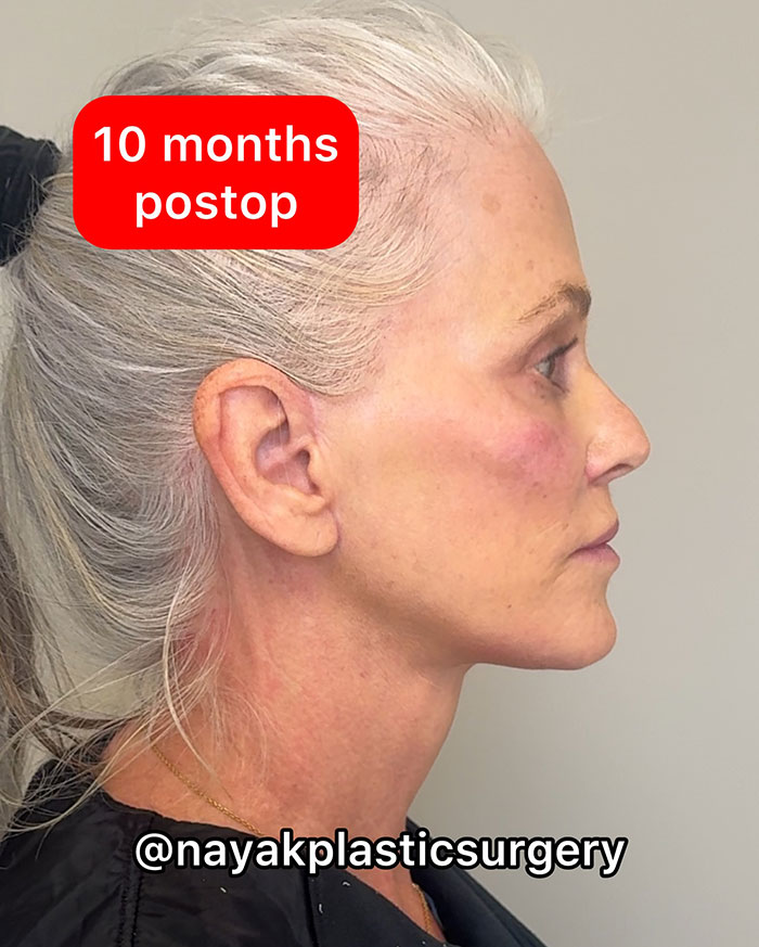 66YO woman 10 months after plastic surgery, side profile showing transformation; hair tied back. 66YO woman 10 months after plastic surgery, side profile showing transformation; hair tied back.