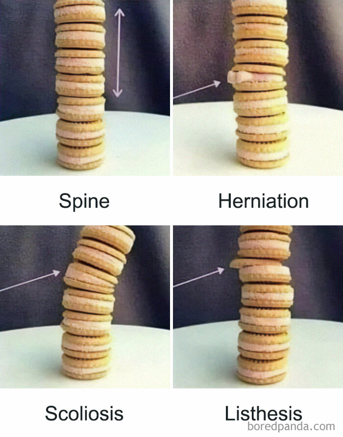 Cookies stacked to depict spine, herniation, scoliosis, and listhesis; a humorous take on medical school concepts.