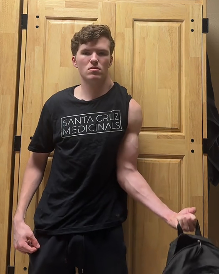 Young man, dubbed "The Crooked Man," showing asymmetrical muscle growth from working out only one side, stands confidently.