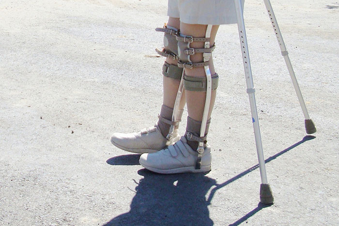 Leg braces on a person standing with crutches, reflecting past norms and changes by 2025.