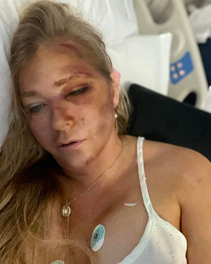 Injured woman with bruises lying in hospital bed, highlighting Virginia Giuffre lawyer doubts in tragic final note case. Injured woman with bruises lying in hospital bed, highlighting Virginia Giuffre lawyer doubts in tragic final note case.