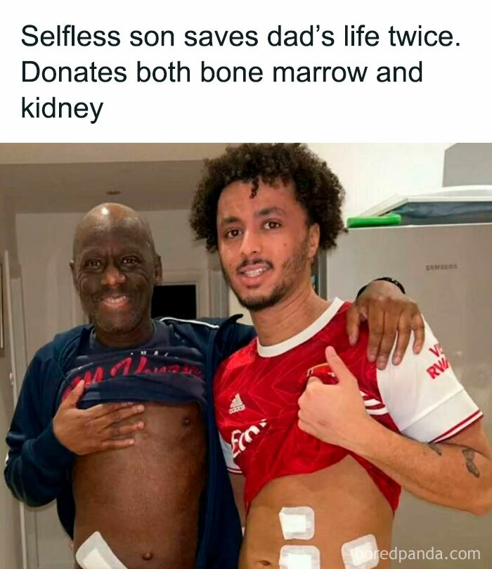 Father and son showing surgery scars, highlighting a positive act of kidney and bone marrow donation.
