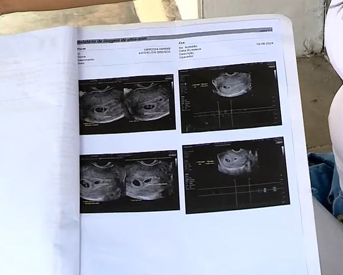 Ultrasound scans held by a pregnant woman expecting twins, showing different views.