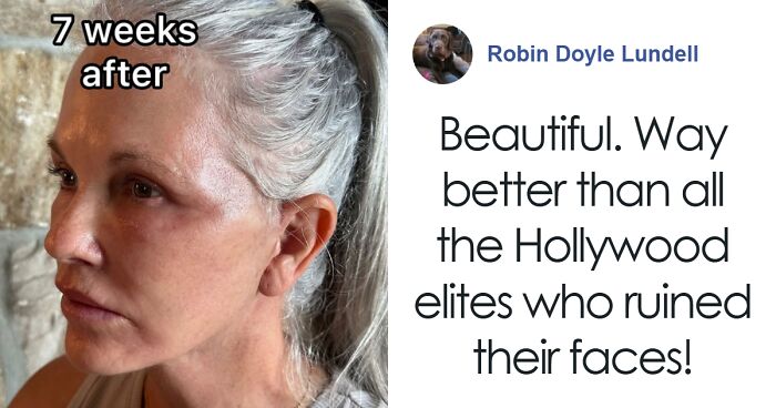 “Phenomenal Results”: 66-Year-Old Woman Undergoes 9 Surgeries In 6 Hours, Breaks The Internet