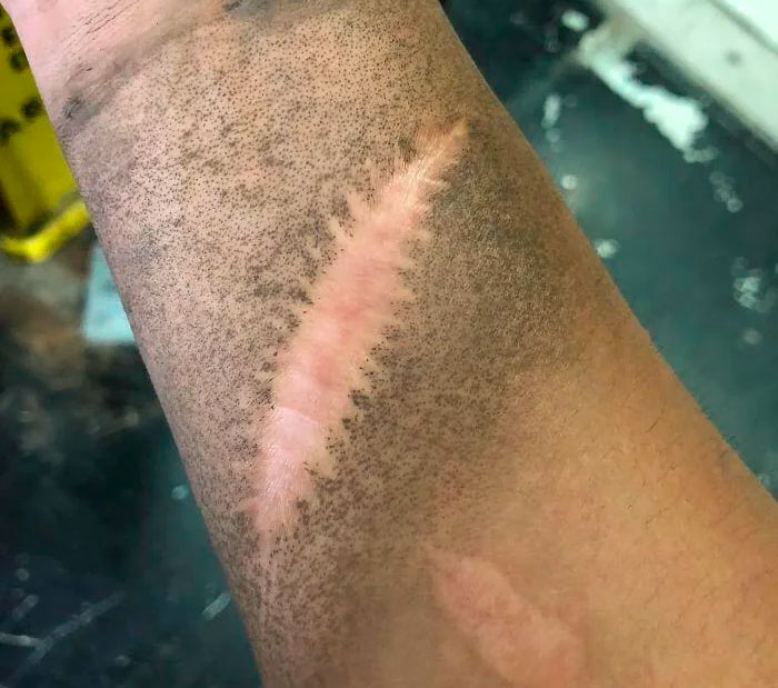 Cicatriz visible en brazo con piel de tono oscuro, mostrando detalles médicos del cuerpo humano impactante.