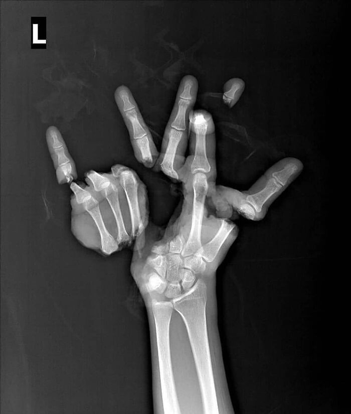 X-ray image revealing an uncanny hand deformity with multiple overlapping fingers and unusual bone structure in medicine.