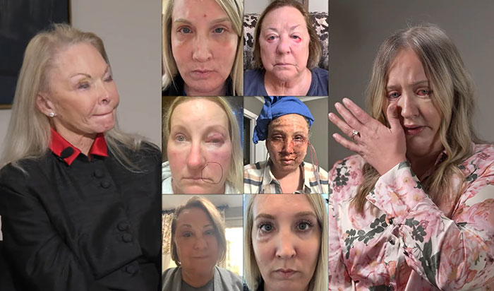 Women showing plastic surgery results after aiming to look refreshed, revealing disfigured faces and emotional reactions.