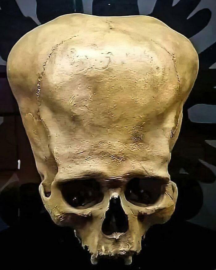 Enlarged ancient skull with elongated cranium displayed in a museum, highlighting unique features of ancient history artifacts.