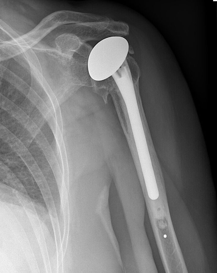 Radiografía de un brazo con prótesis metálica, destacando hallazgos extraños según expertos en autopsias.