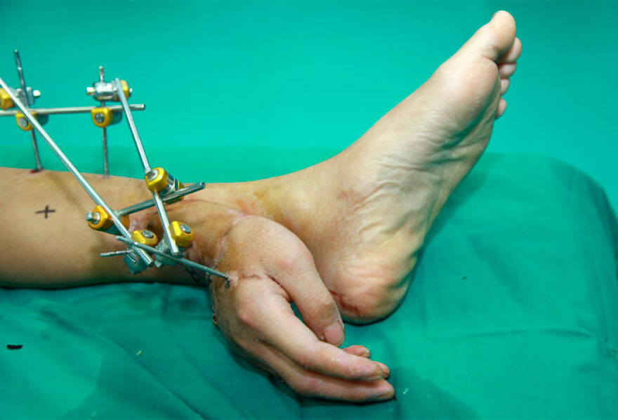 Severed hand attached to man's ankle with medical device to preserve it for reattachment surgery.