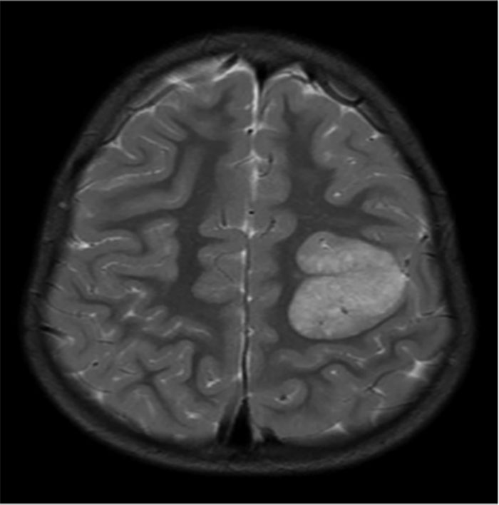 MRI scan of a human brain showing unusual growth found during bizarre and unexpected discoveries in autopsies.