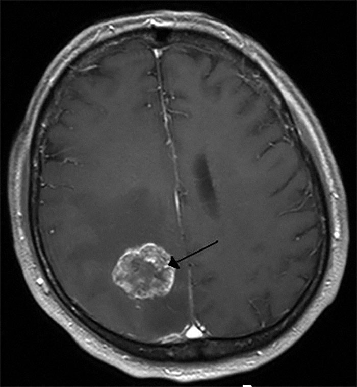 MRI brain scan showing a rare abnormality highlighted by an arrow, one of the bizarre discoveries found during autopsies.