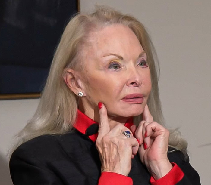 Older woman showing plastic surgery results, highlighting issues faced with a disfiguring cosmetic procedure.