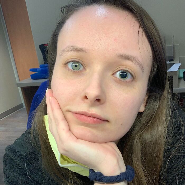 Young woman with heterochromia showing unique eye color difference, highlighting rare and interesting genetic traits.