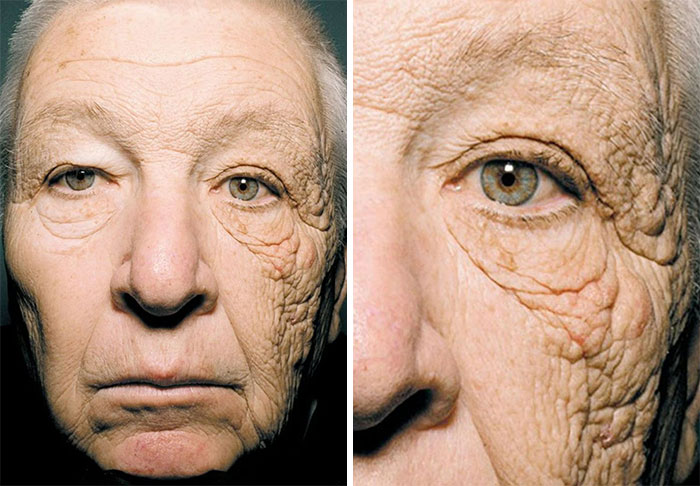 Primer plano de rostro con arrugas profundas que muestran efectos médicos sorprendentes del cuerpo humano.