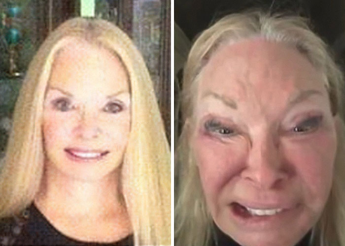 Before and after photos of women who wanted to look refreshed but were disfigured by a plastic surgeon.