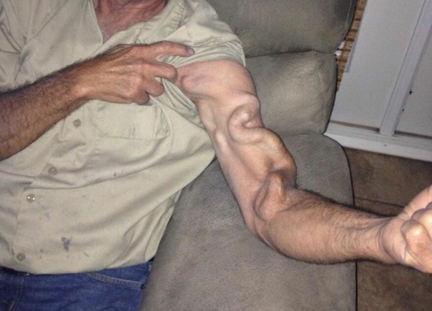 Person with a bizarre twisted arm showing an unusual medical condition featured on an IG account sharing eerie medical pics.