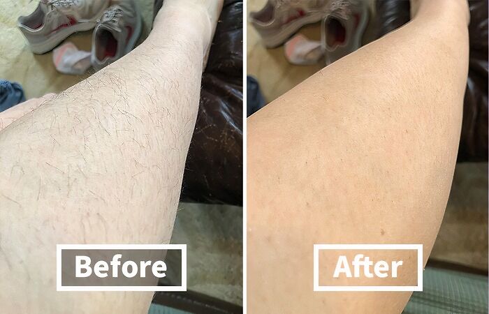 Before and after images showing smooth skin results from top beauty MVPs tackling awkward skin issues.