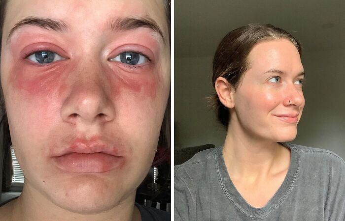 Before and after images showing the effectiveness of beauty MVPs in treating awkward skin issues and redness.