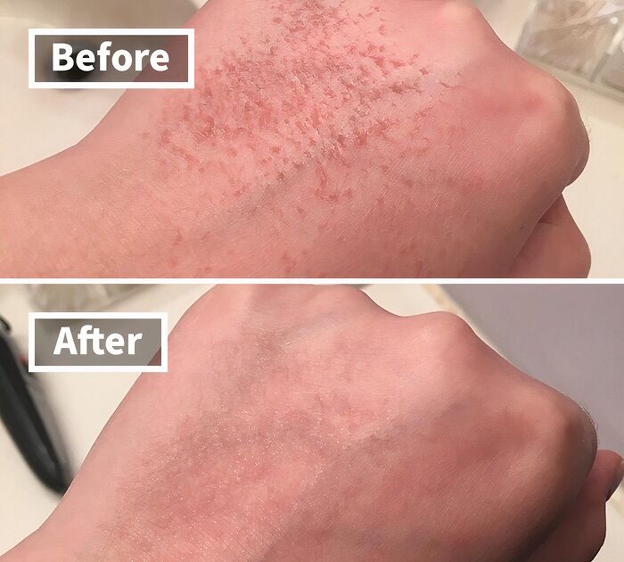 Before and after close-up of dry, flaky skin on a hand showing beauty MVPs tackling awkward skin issues effectively.