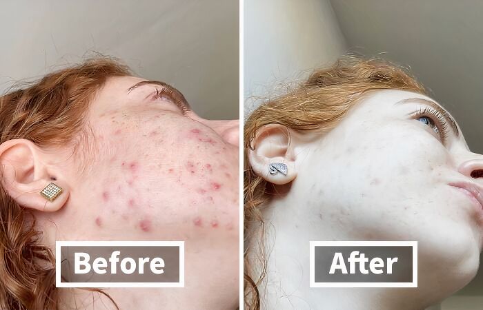 Before and after close-up of a young woman’s face showing problem-solvers for skin improvement and getting your life together.