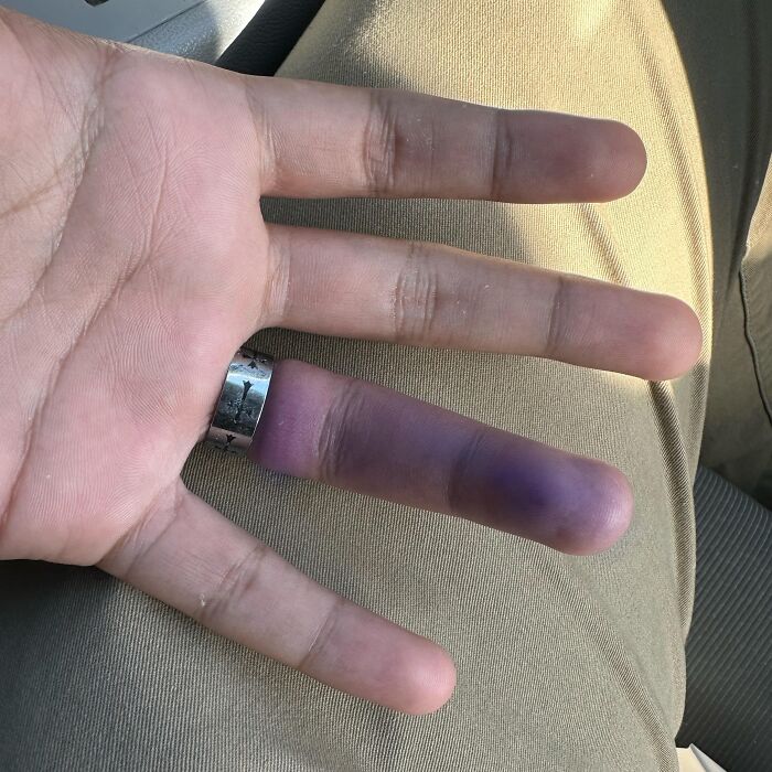 Hand with a severely bruised finger wearing a ring, illustrating bad Friday the 13th moments people are begging you to hold their beer.